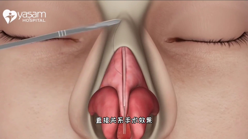 看了还敢做这手术吗,驼峰鼻整形手术过程,3d演示.