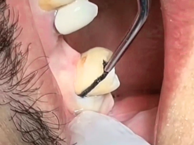 牙齿里面有黑线,太呛人了