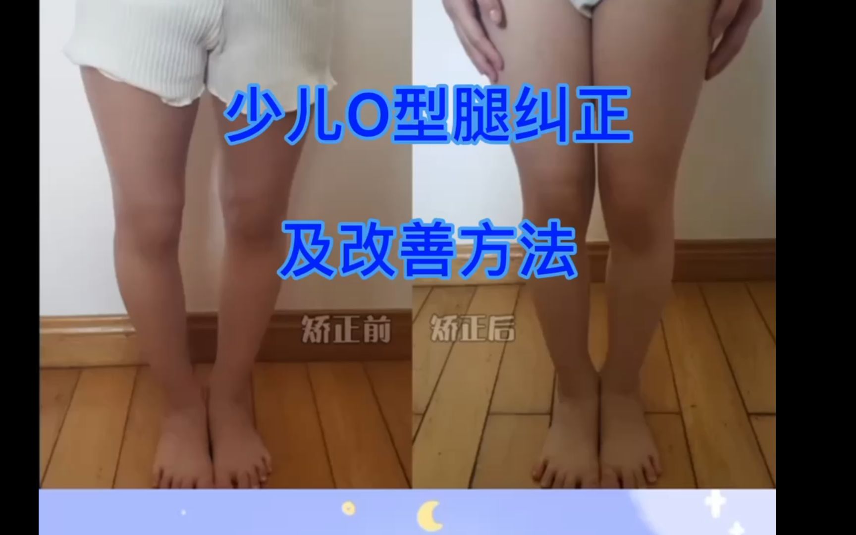 【体态矫正】少儿O型腿矫正改善教程来啦.哔哩哔哩bilibili