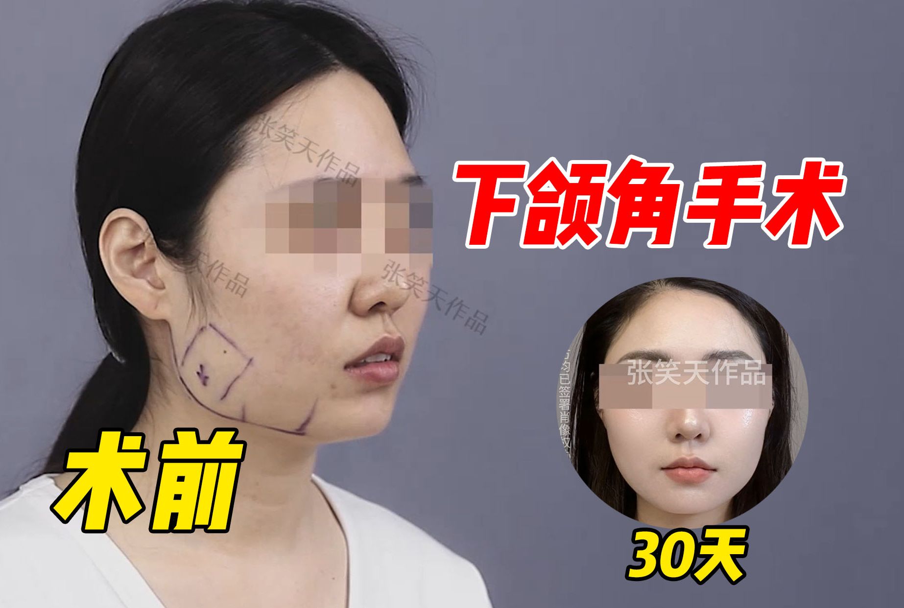 【张笑天】严谨派手术,女博士下颌角经历,“我查了好多论文才来的”哔哩哔哩bilibili