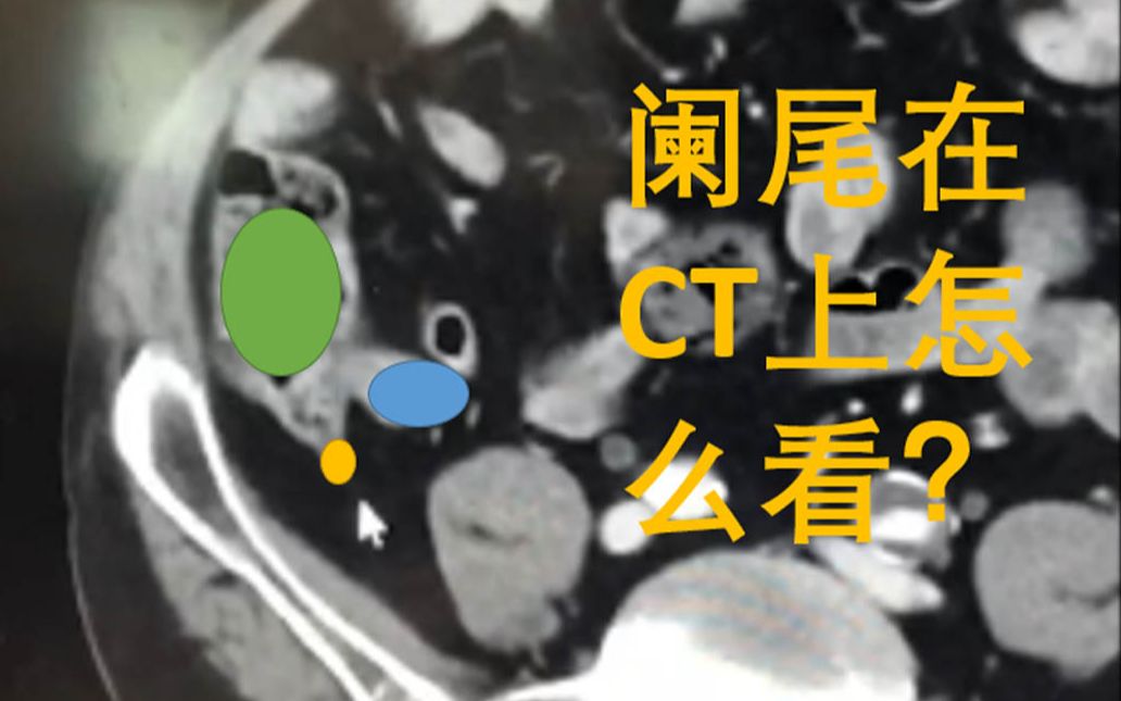 阑尾ct图解图像图片