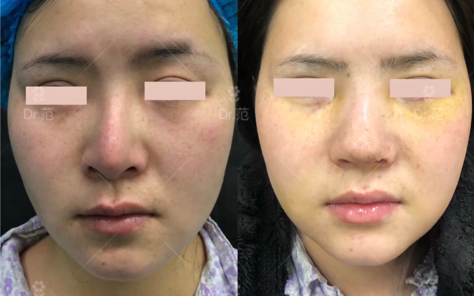 鼻翼缘退缩矫正,拒绝植皮