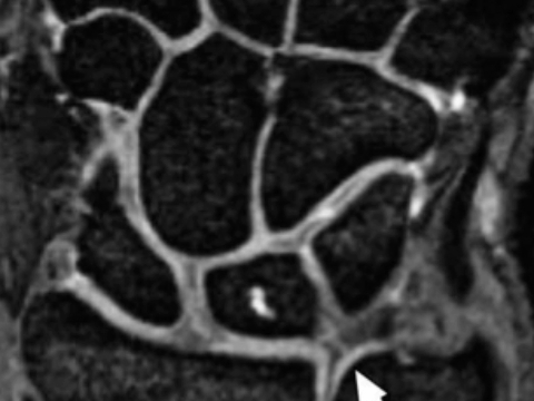 外伤后持续的手腕尺侧疼痛,拍片、CT均未发现异常.这种损伤需要薄层的MR才能清晰显示出来.哔哩哔哩bilibili