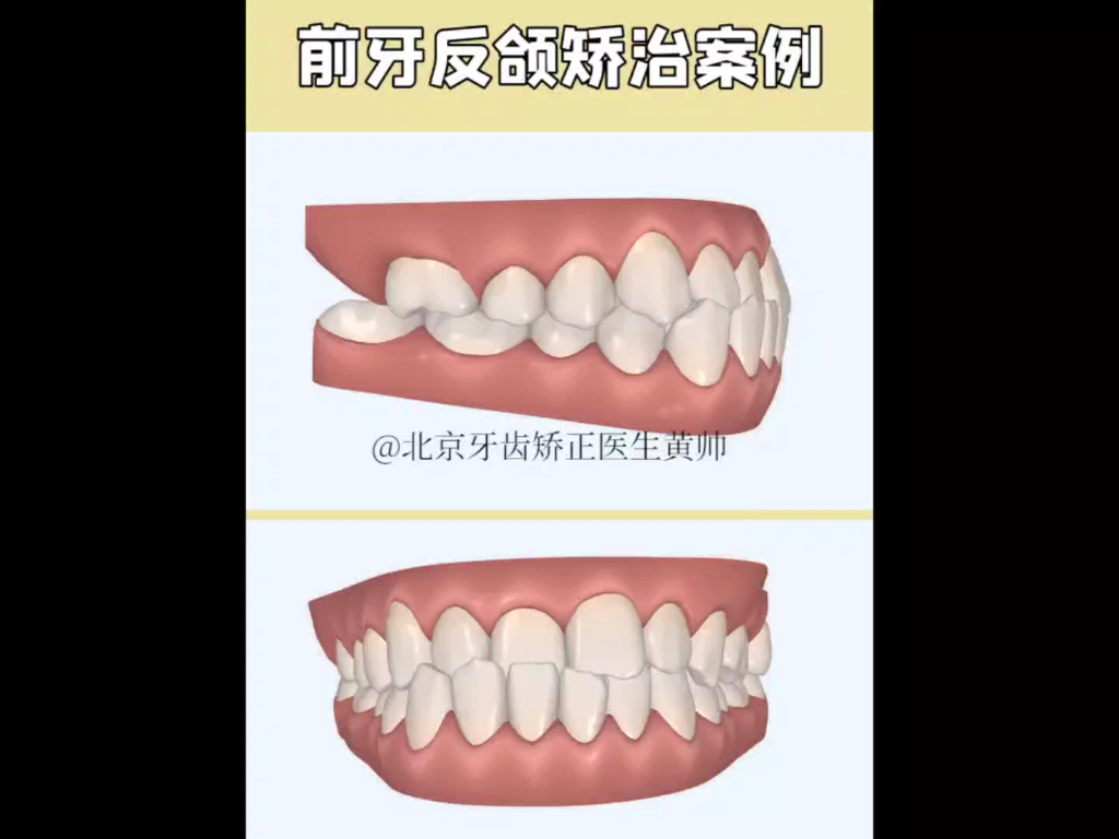 【前牙反颌隐适美矫正案例】在牙性三类错哔哩哔哩bilibili