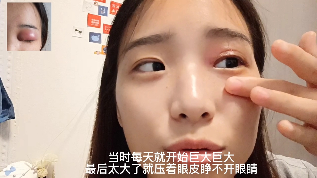 麦粒肿恢复期的女大毕业学生的暑假自我反省哔哩哔哩bilibili