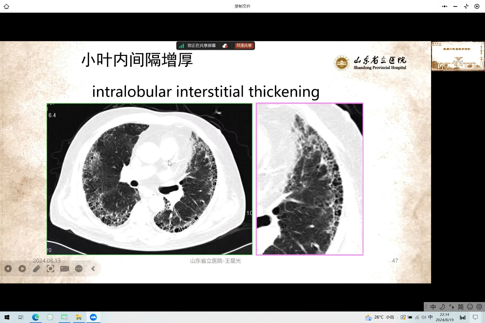 肺部感染的CT表现哔哩哔哩bilibili