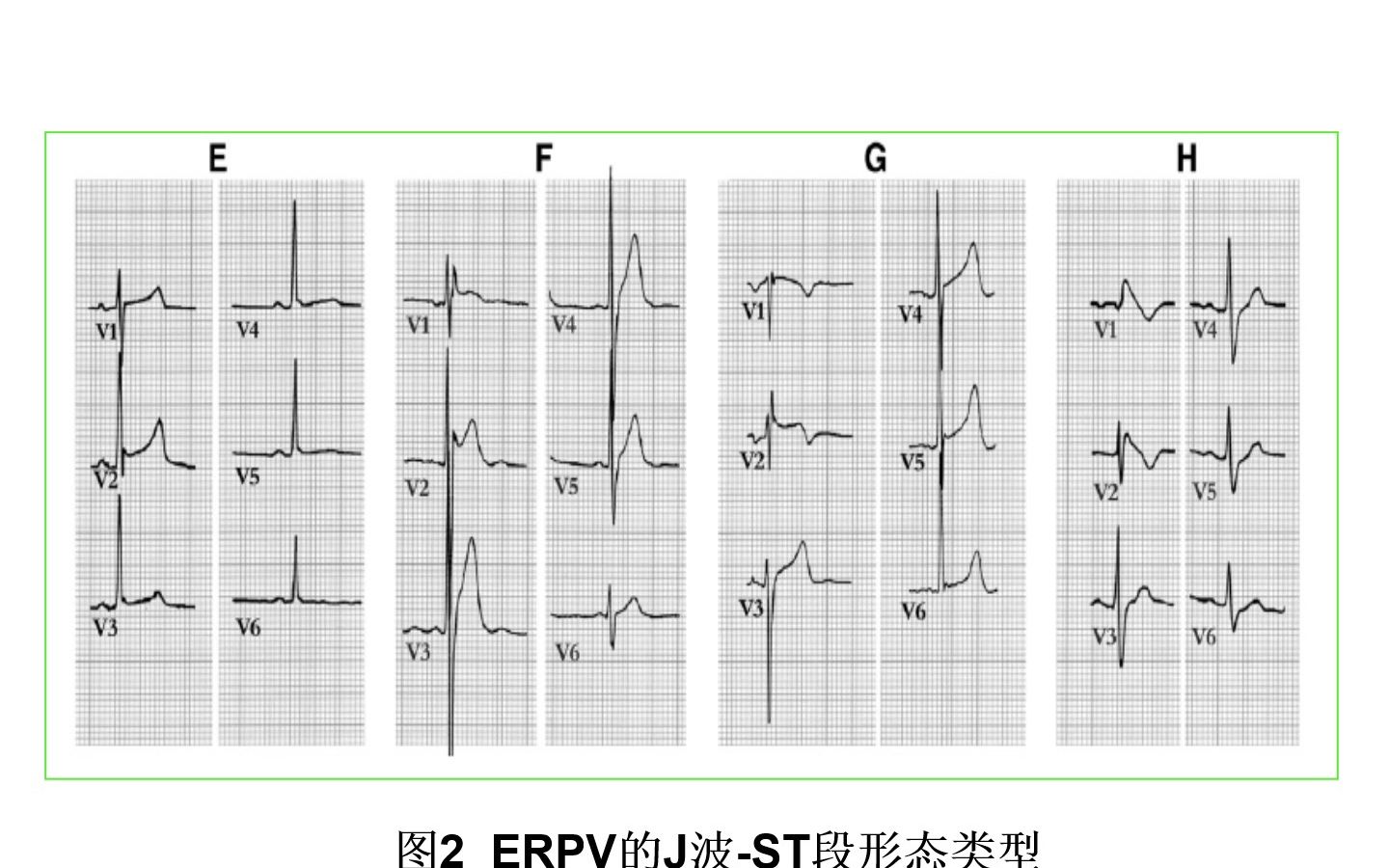 临床常见心电图判读PPT哔哩哔哩bilibili