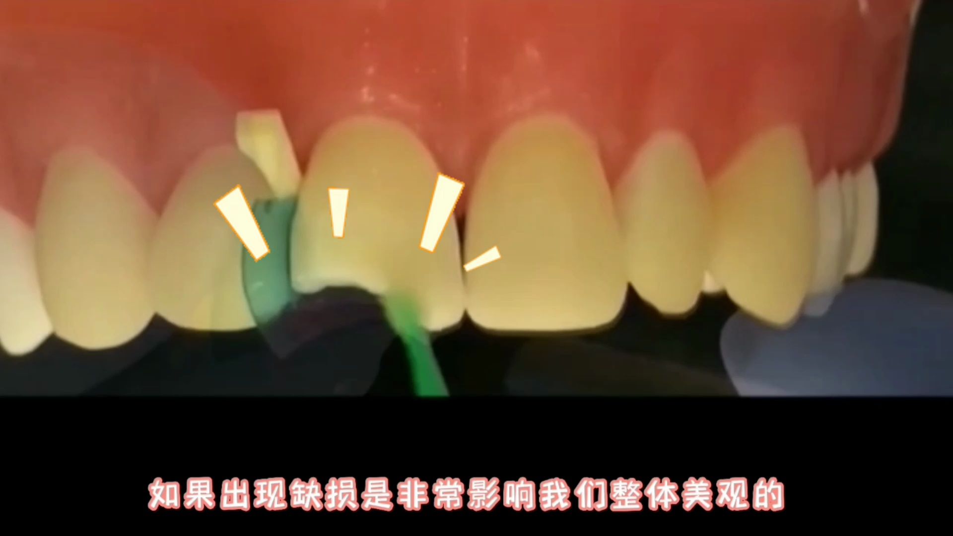 牙齿美学修复-门牙缺损