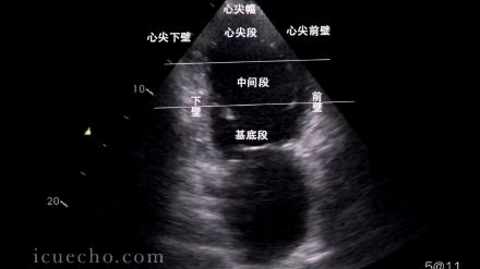 左室壁分段超声方法,目前国内大多数医院,都是采用美国心脏病协会(AHA)划分的17节段划分法哔哩哔哩bilibili