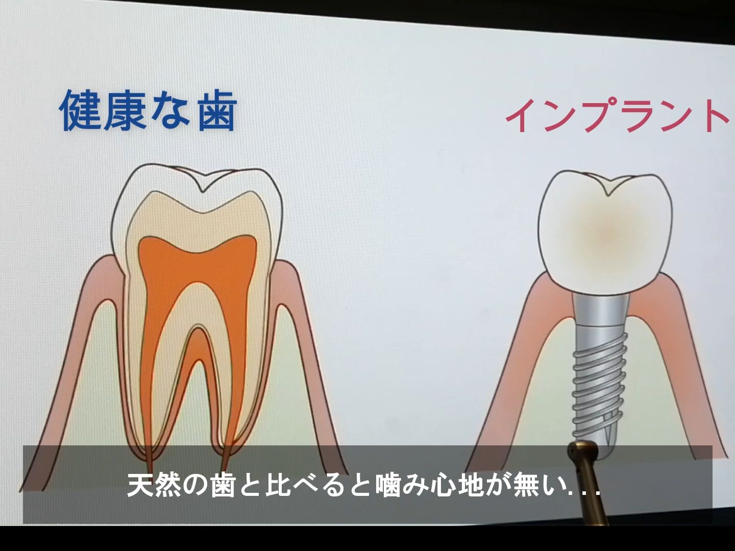 下一代种植牙和牙齿再生医疗【次世代インプラント!】歯の再生医療も