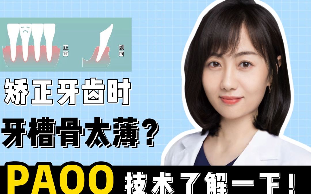 正畸时牙槽骨太薄?PAOO技术了解一下!哔哩哔哩bilibili