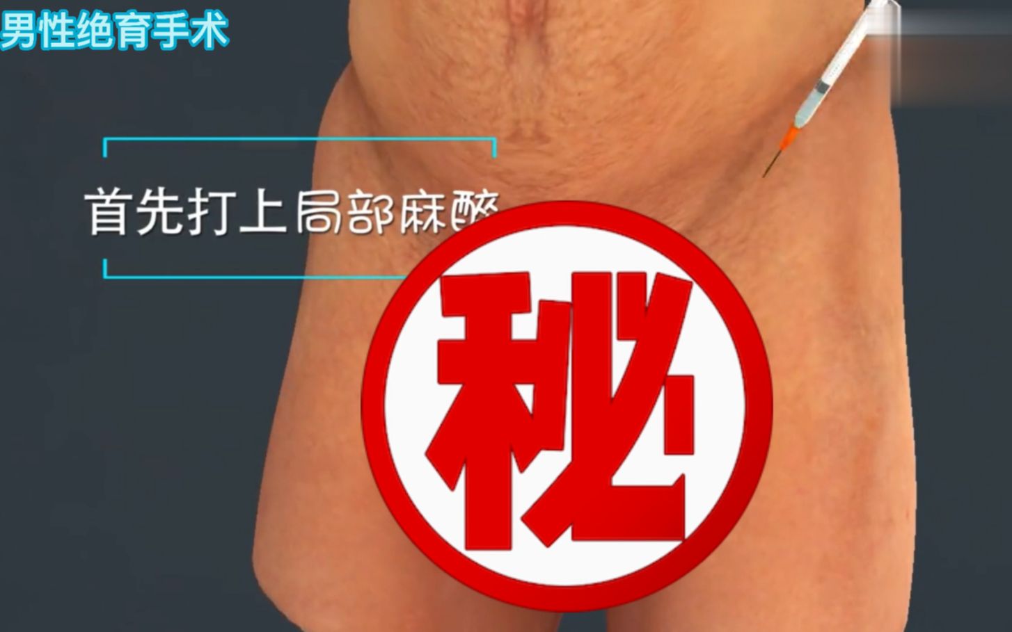 3动画视频:男性绝育手术哔哩哔哩bilibili