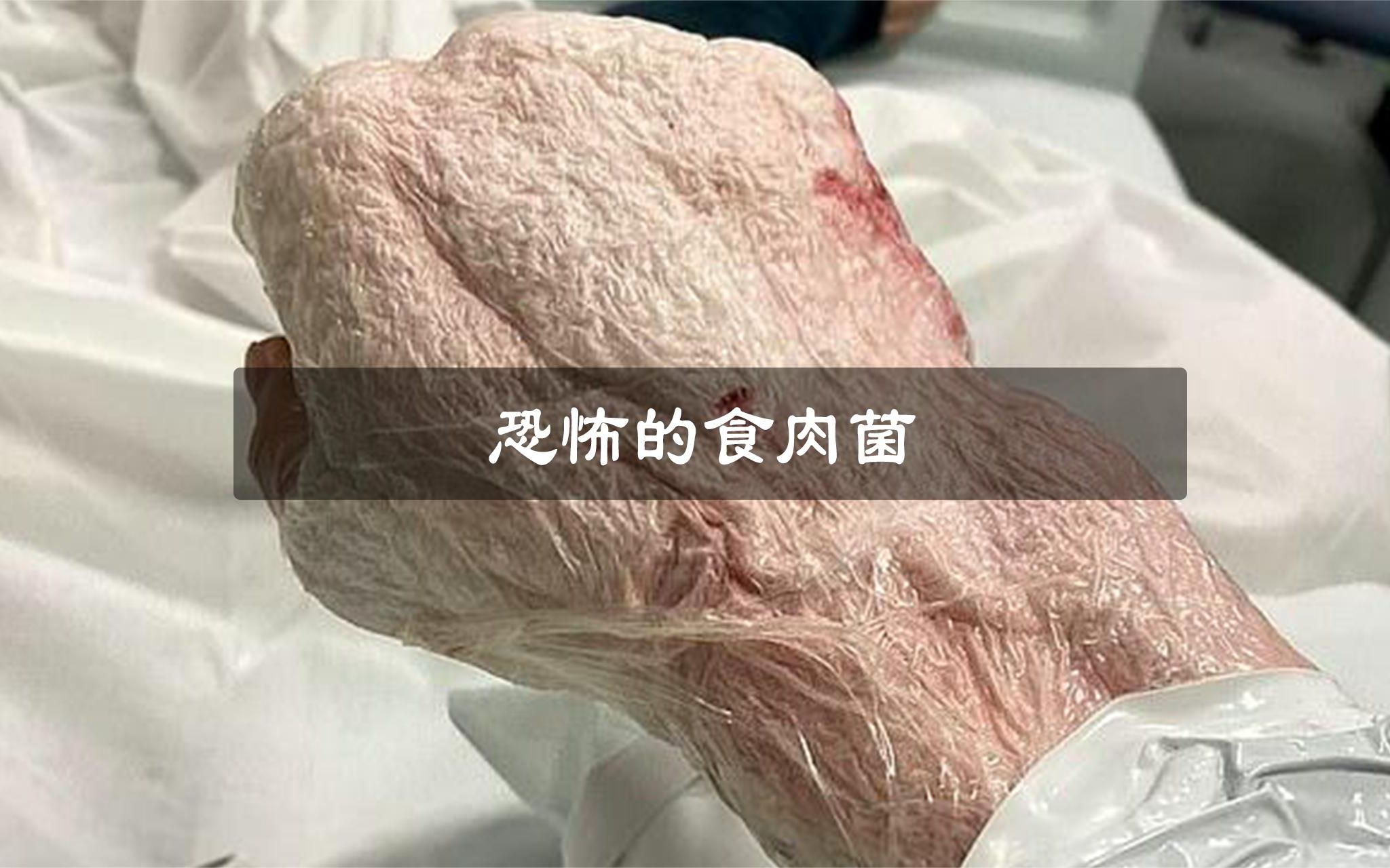 [图]存在逾百年,能吞噬你器官的恐怖病菌!关于噬肉菌,你了解多少_