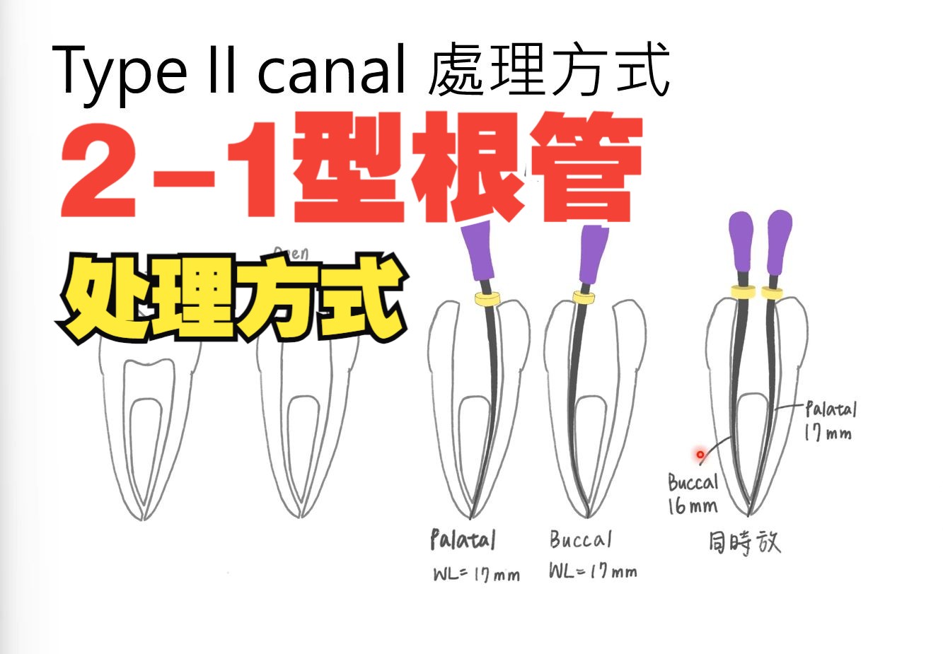 21型根管的处理方式:简单解释Type II canal 处理方式 ft. 李玟叡医师哔哩哔哩bilibili