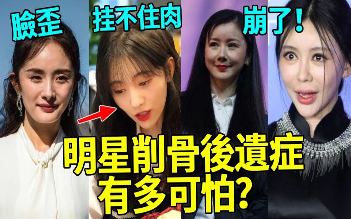 明星狠心削骨后遗症有多可怕? 脸歪僵硬,挂不住肉,花百万都无法修复!