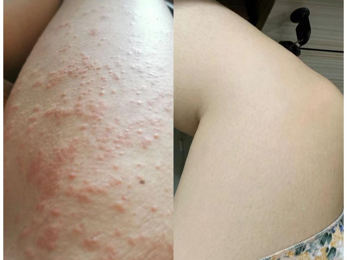 大腿根起疹子脱屑瘙痒来来回回老不好,康复者自用的止痒法子,皮肤白净