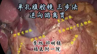 三步法逆向游离胃（单孔腹腔镜 食管癌手术） 邱明链教授供稿