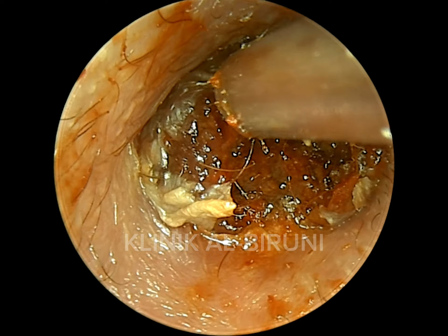 掏耳朵解压-油性和粘性耳垢与令人满意的耳朵清洁视频