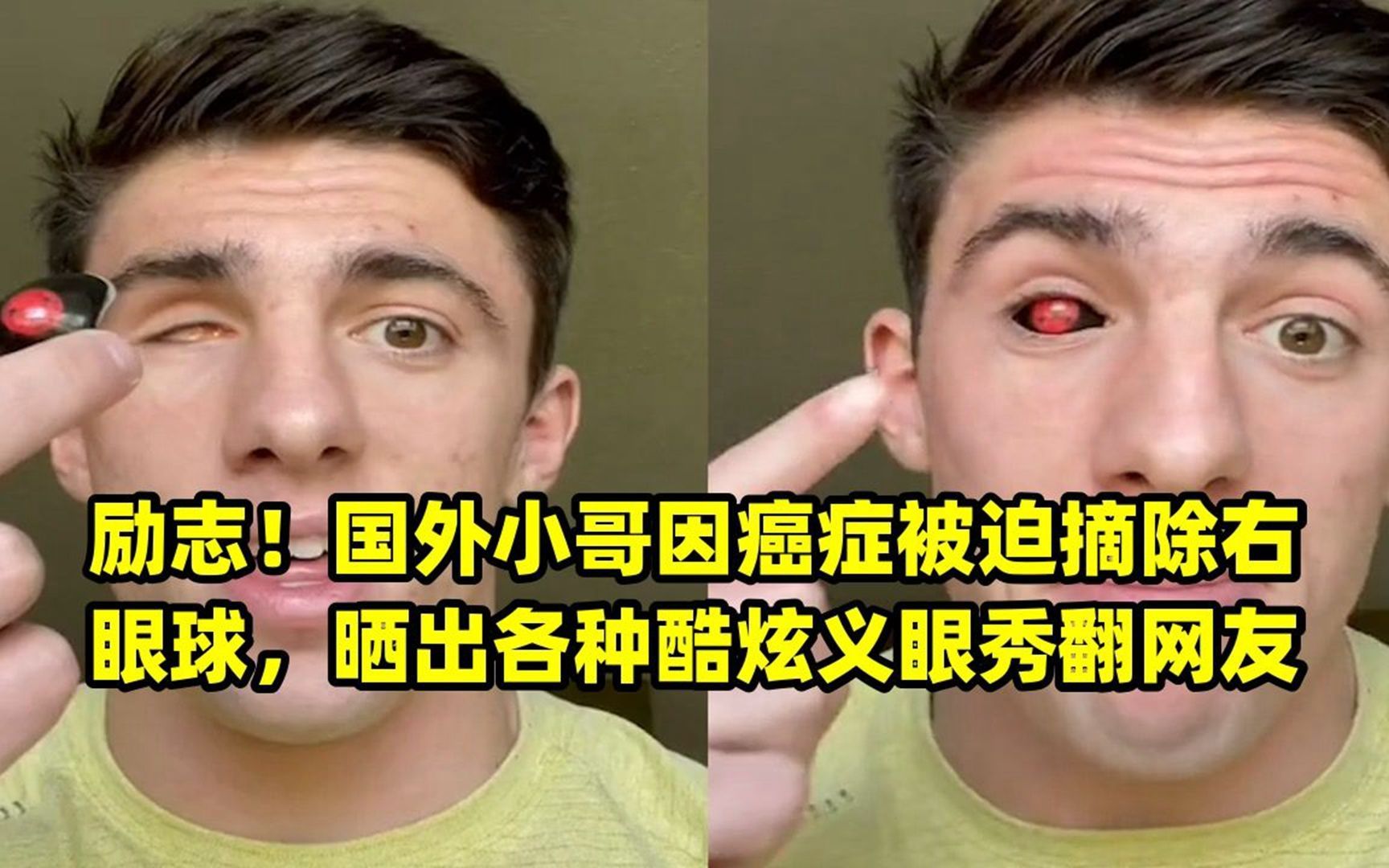 励志!国外小哥因癌症被迫摘除右眼球,晒出各种酷炫义眼秀翻网友