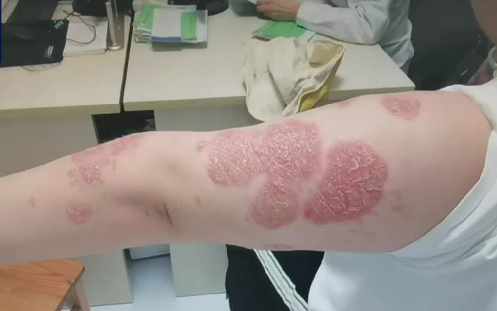 牛皮癣爬满女子全身,手臂大块红斑,头皮掉屑严重剃头治疗