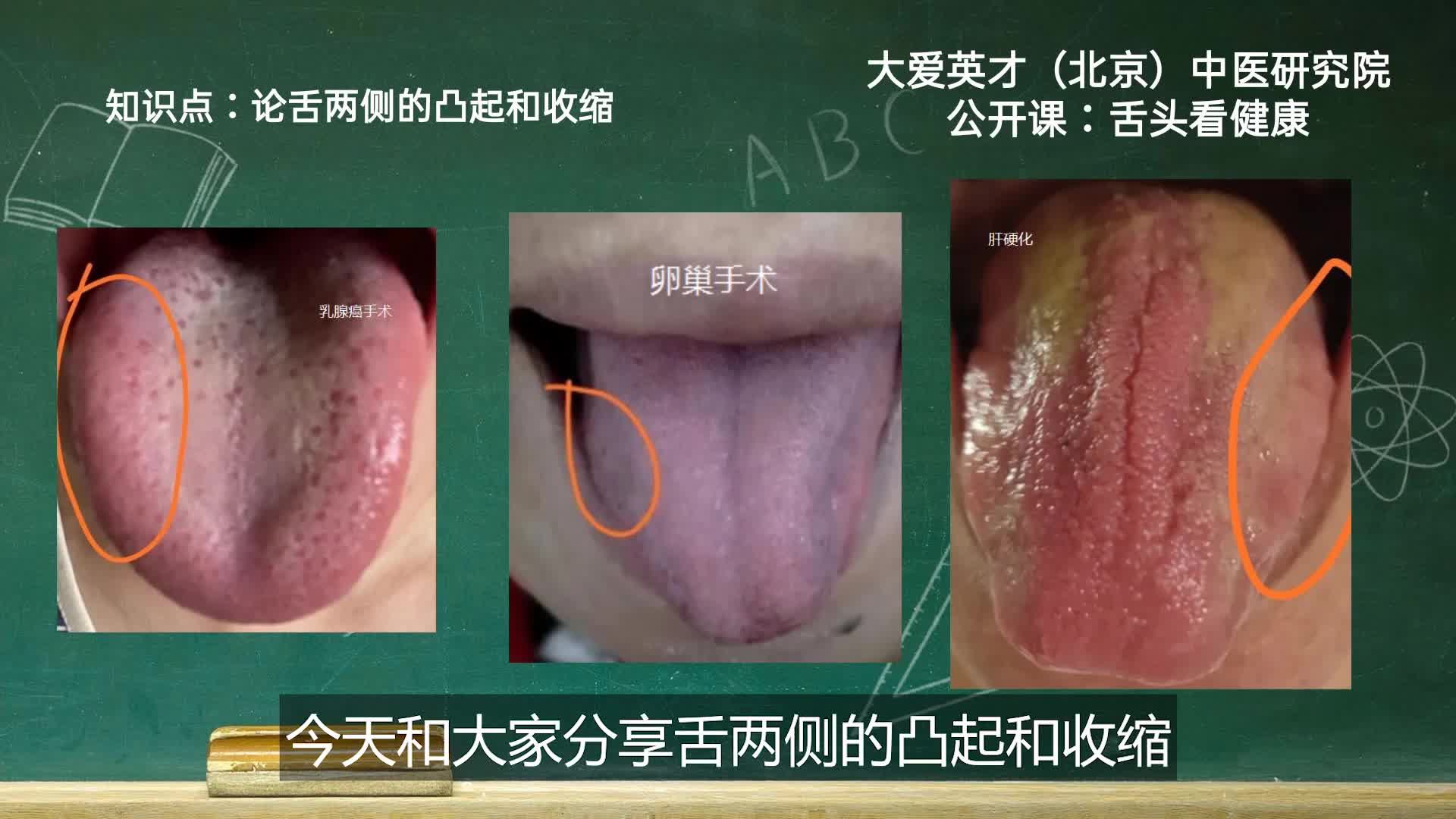 舌象分析:舌两侧肝胆反射区有凸起提示体内肝脏有实质性的病变