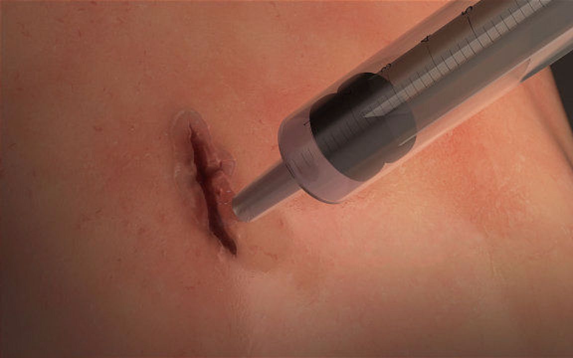 这个神奇的胶水可以直接把伤口粘上1分钟就愈合