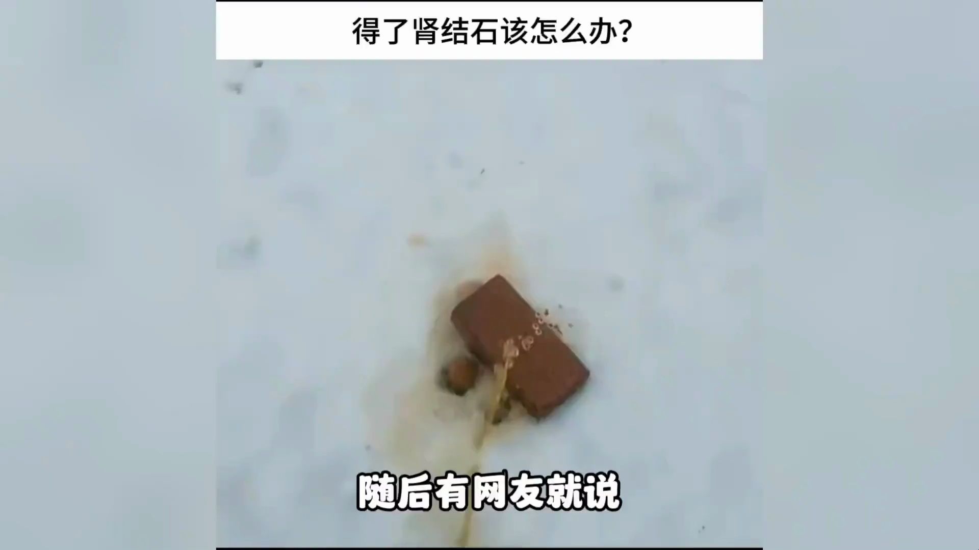 得了肾结石该怎么办?哔哩哔哩bilibili