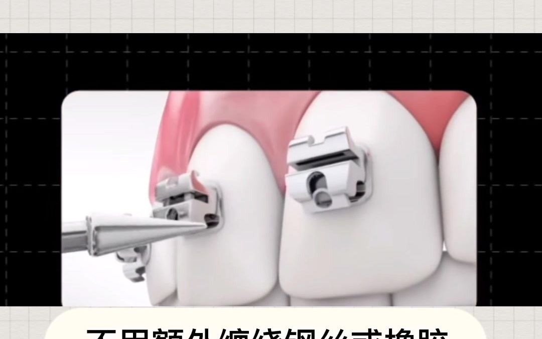 【深圳牙齿矫正】选择什么矫治器好呢?哔哩哔哩bilibili