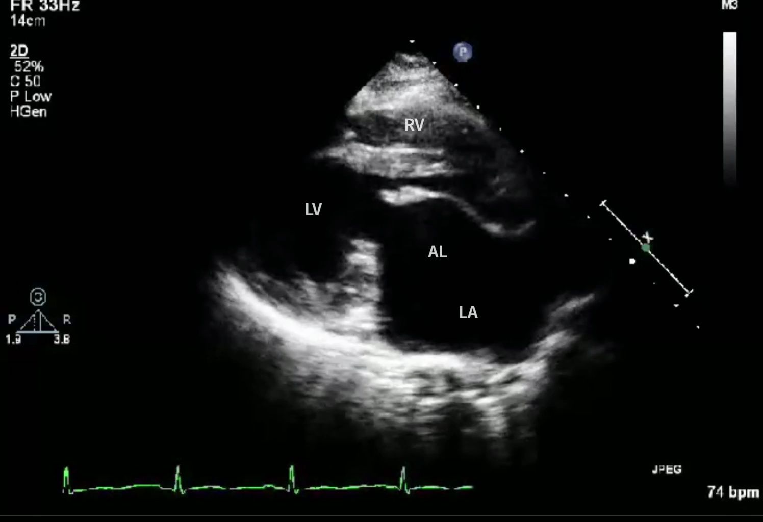 二尖瓣脱垂 Mitral Valve Prolapse哔哩哔哩bilibili