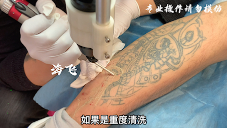 东莞深圳广州洗纹身