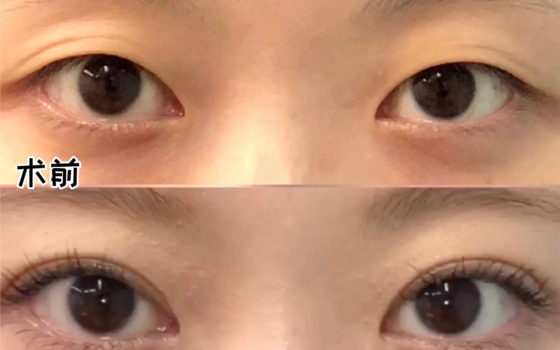 直接决定眼睛是否做到"妈生眼"的双眼皮形态,过于追求夸张的眼型,只能