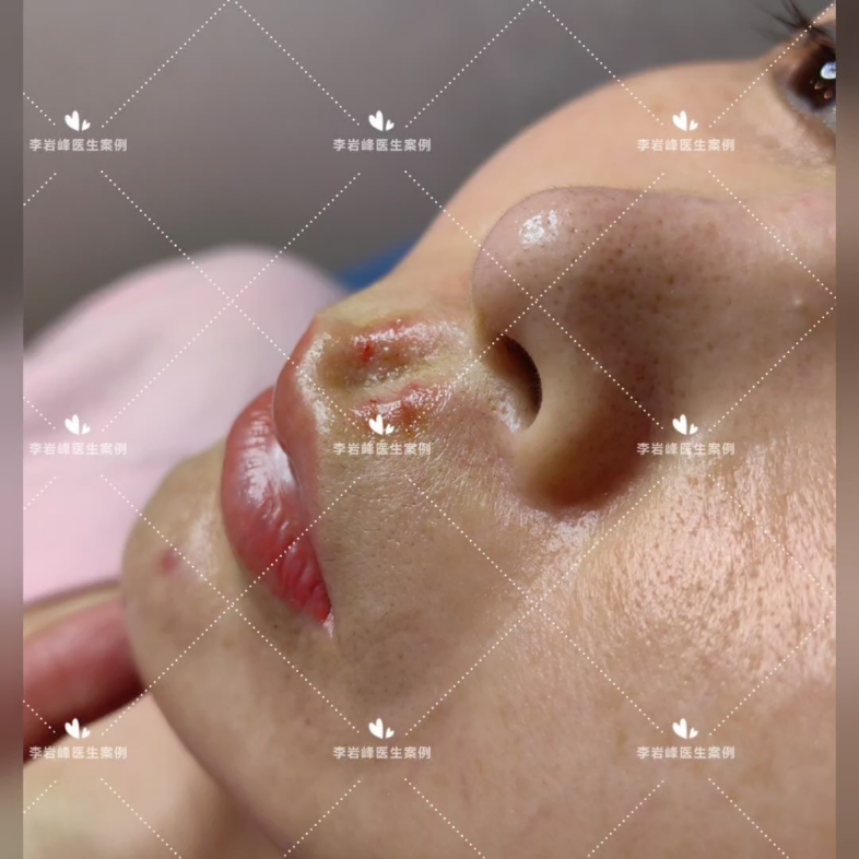 人中沟加深 人中窝加深效果反馈