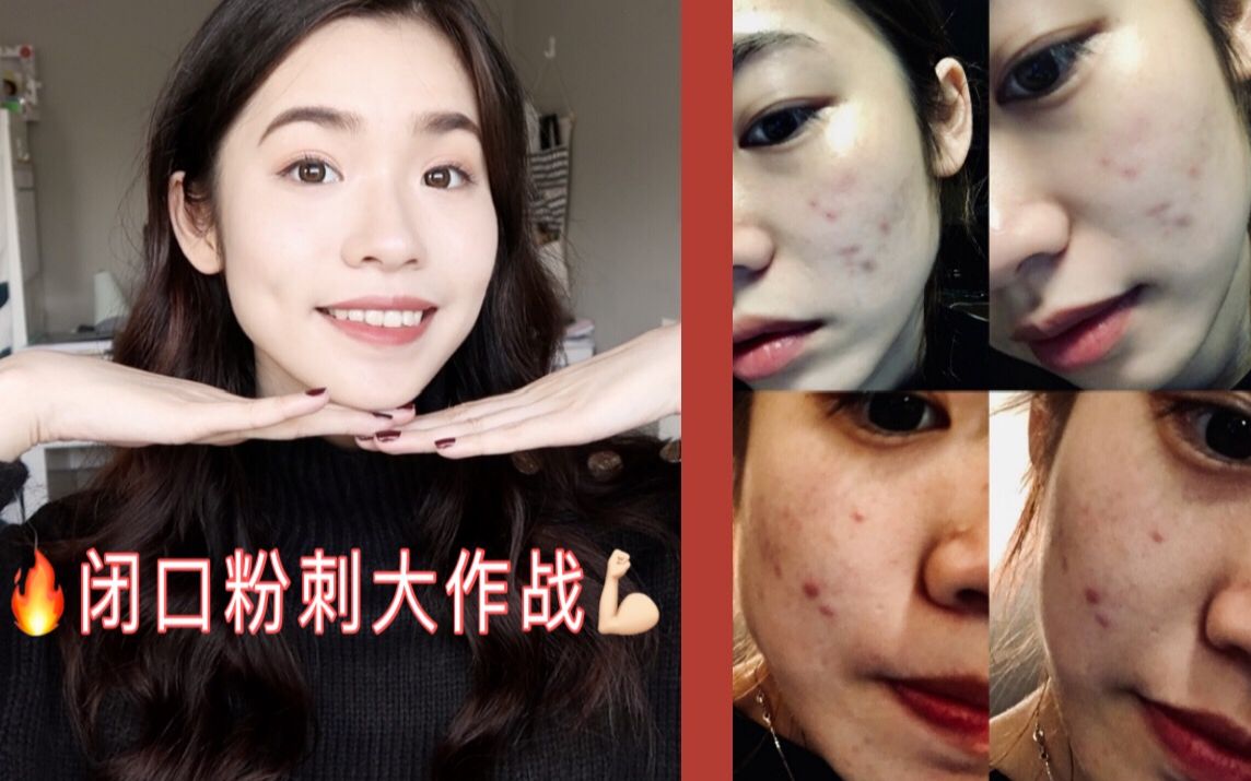 一起打败痘痘闭口粉刺!两个月我的祛痘故事 My Acne Story哔哩哔哩bilibili