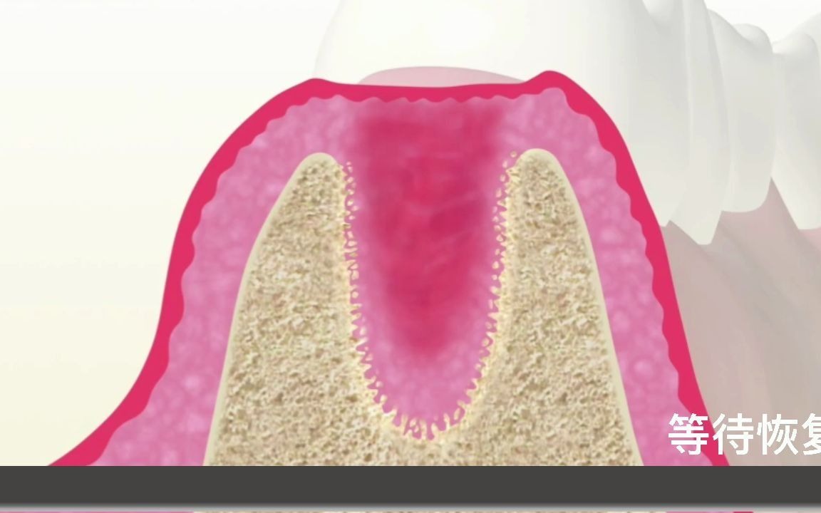 智齿拔掉后这个牙窝洞是怎么恢复的?为什么食物残渣掉进去也不会包在洞里哔哩哔哩bilibili