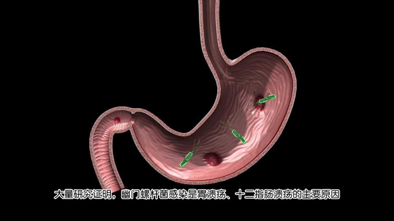 胃溃疡原因图片