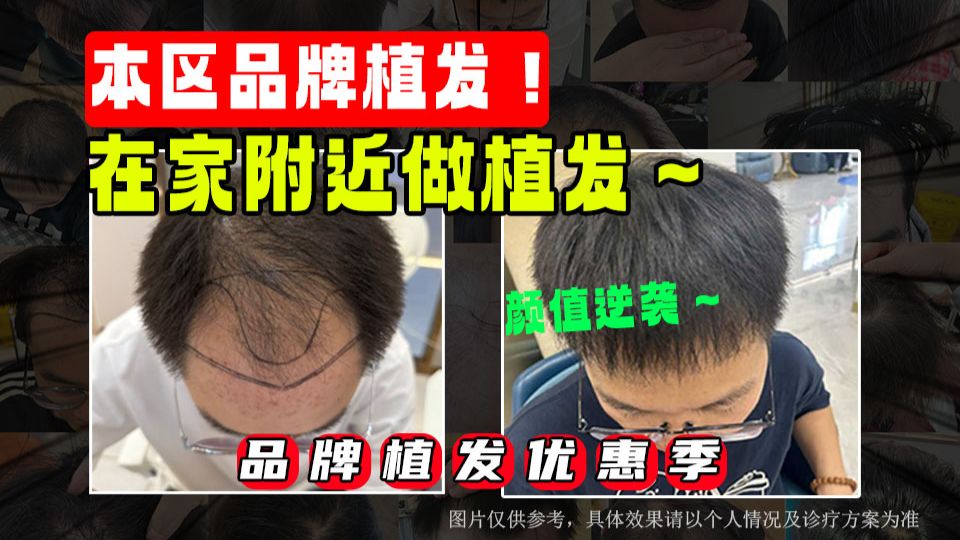 植发专享！品牌植发，在家附近就能做！
