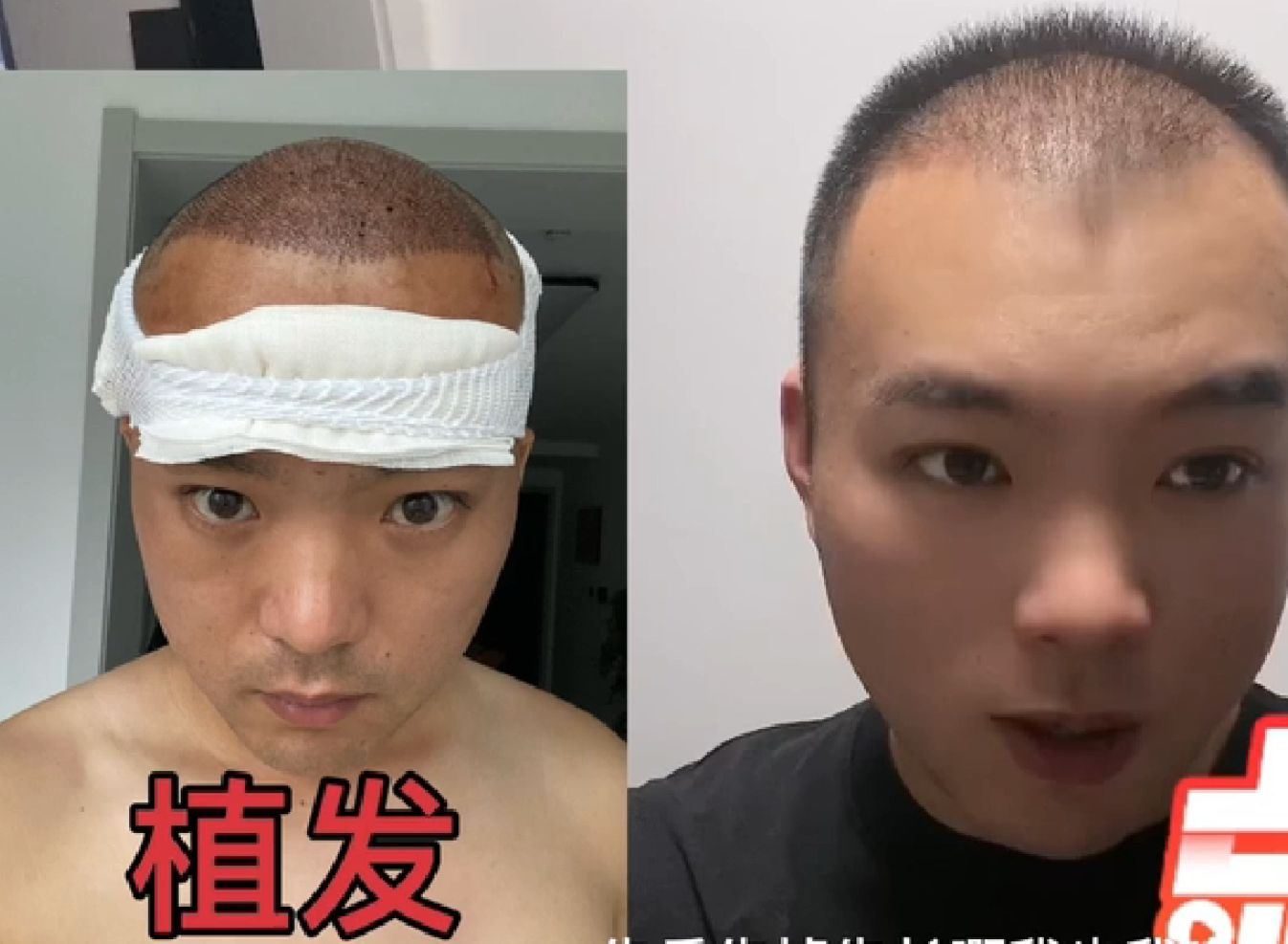 虫虫医美植发的简单介绍