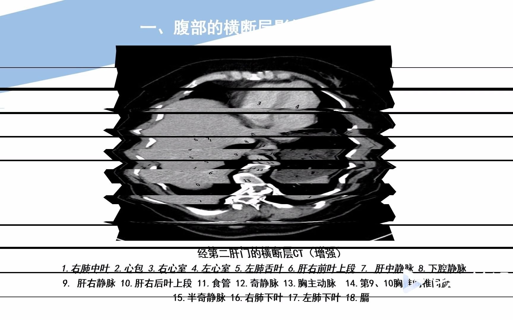 放射医学技术知识点38腹部的断层解剖(五)哔哩哔哩bilibili