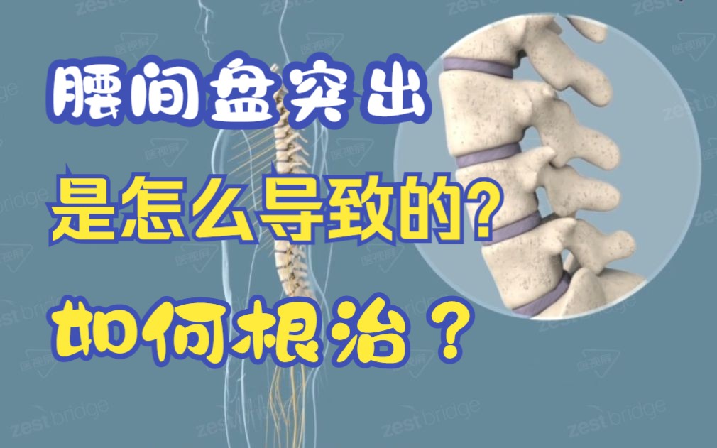 [图]【医学3D】腰间盘突出的发生原理及治疗