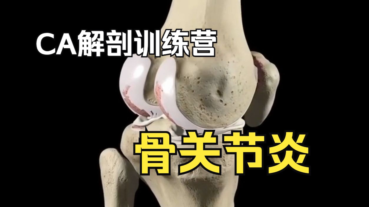 【硬核干货】骨关节炎 Tricompartmental Osteoarthritis(中英双语)哔哩哔哩bilibili