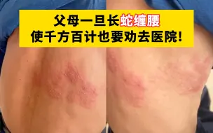 Download Video: 【科普】一旦发现父母腰背部长这种小水泡，不管咋劝，都要在72小时内劝去医院！