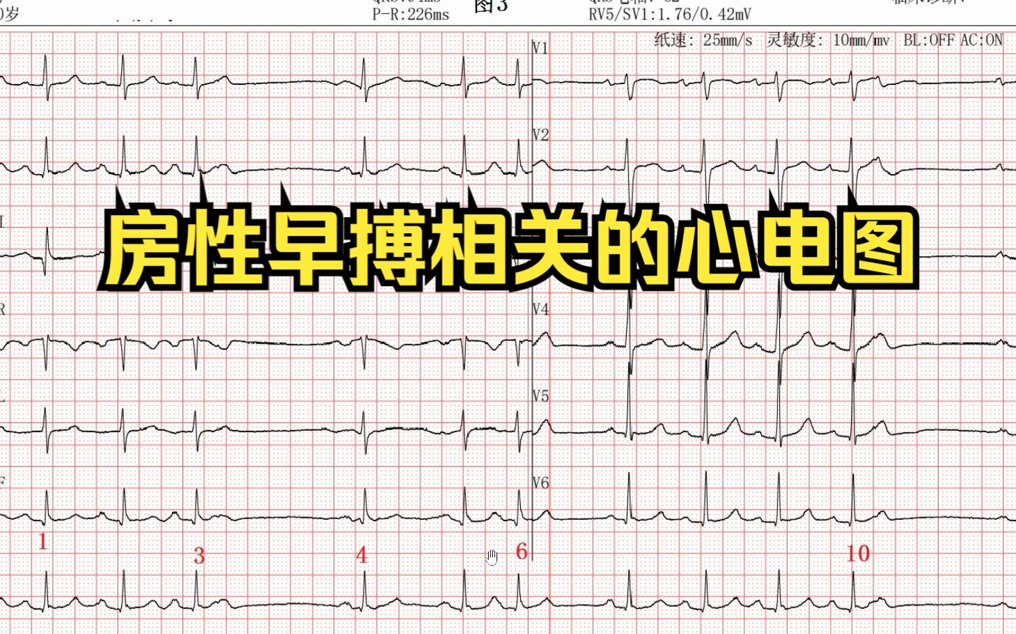 房性早搏相关的心电图哔哩哔哩bilibili