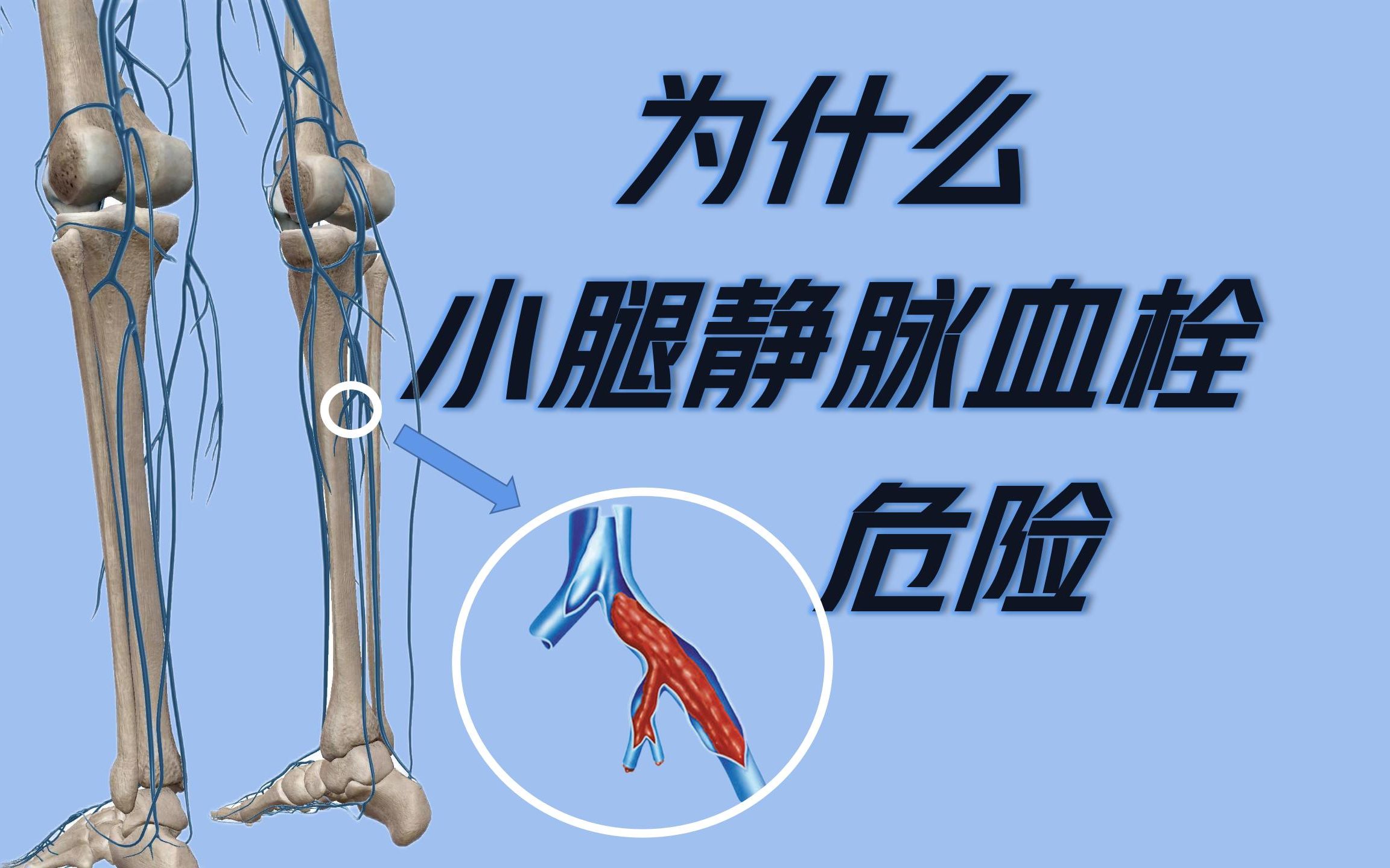 小腿静脉血栓形成的危险因素以及如何预防(6条生活建议)哔哩哔哩bilibili