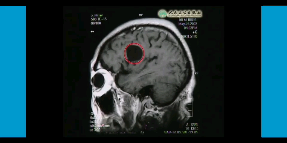 【人体寄生虫学】脑包虫病MRI表现哔哩哔哩bilibili