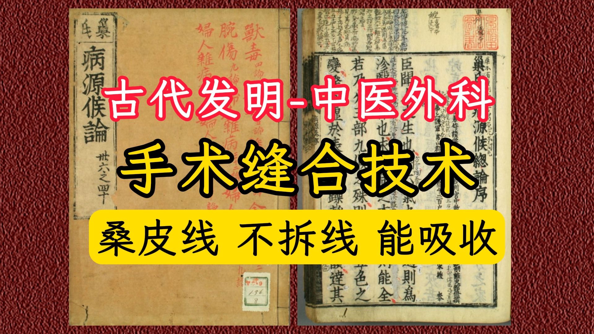 古籍诸病源候论医心方中医外科8字缝合法,使用的桑皮线,无需拆线可被人体吸收哔哩哔哩bilibili