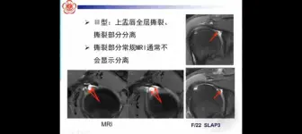 Descargar video: 肩关节盂唇损伤磁共振表现