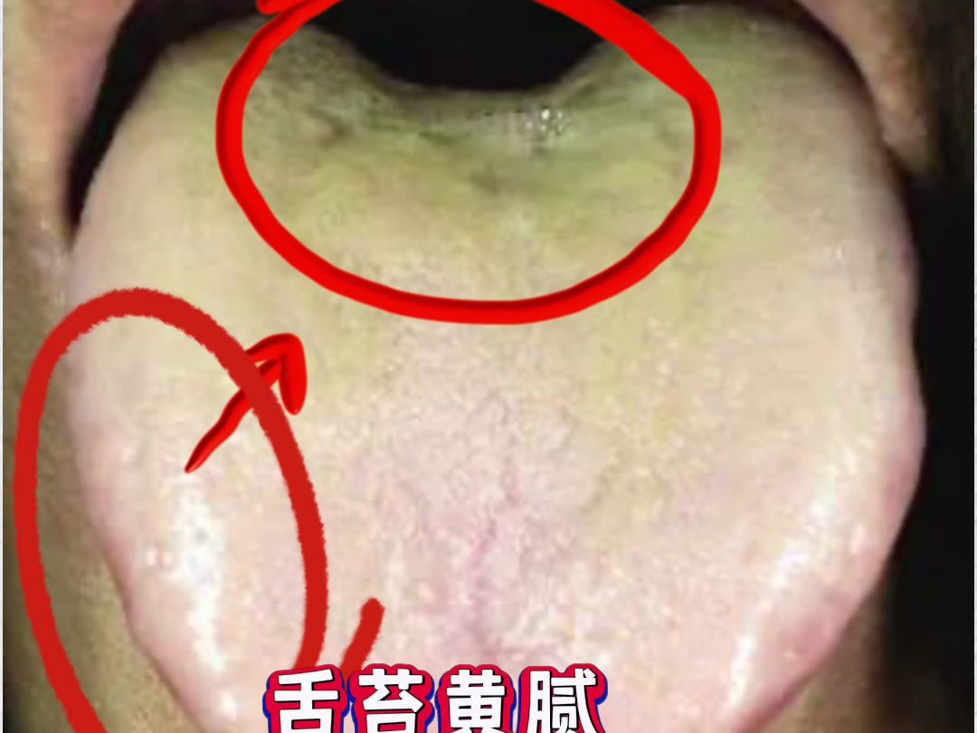 舌诊分析:舌苔黄腻,两边有明显齿痕,中焦有凹陷