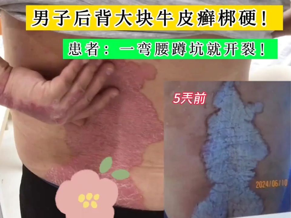 男子后背大块牛皮癣梆硬!患者:一弯腰蹲坑就开裂!