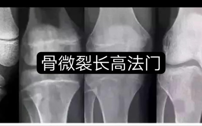 骨微裂长高法门