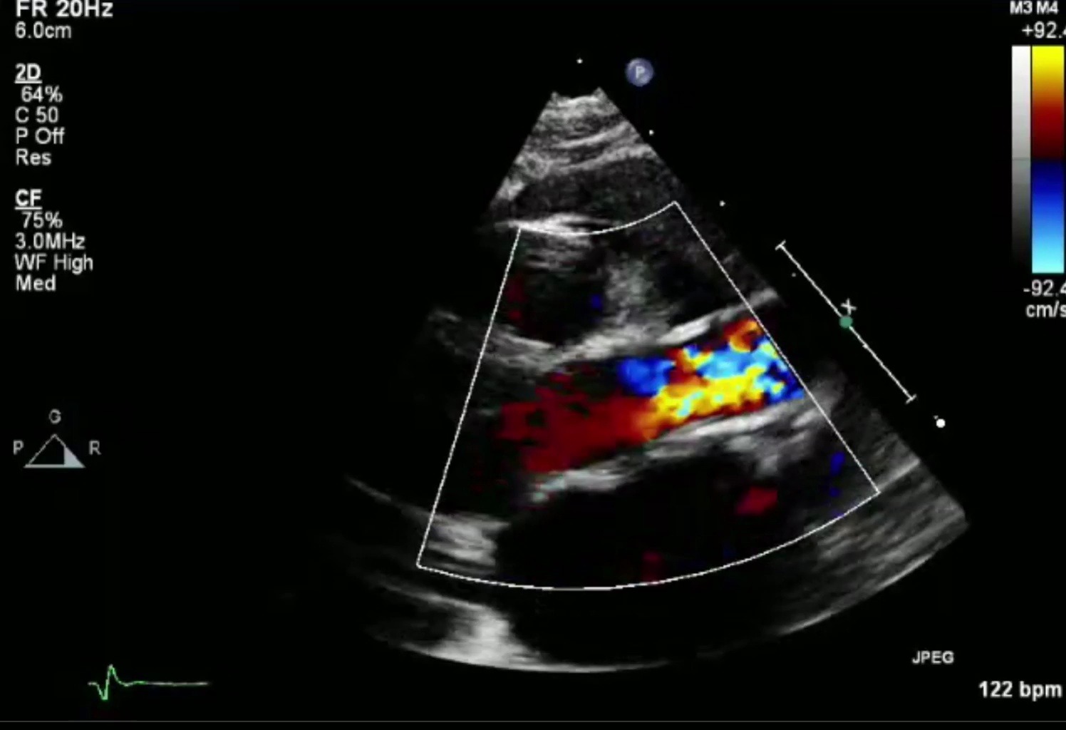 主动脉瓣上狭窄 Supravalvar Aortic Stenosis哔哩哔哩bilibili